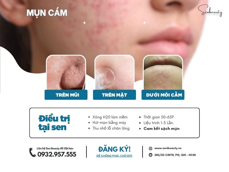 Trị các loại mụn nhọt trứng cá có cam kết